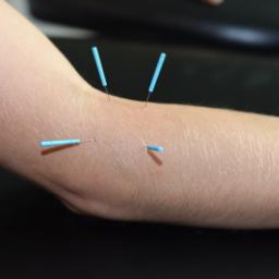 Gabinet Masażu i Chiropraktyki - Przedramię pacjenta z czterema akupunkturowymi igłami z niebieskimi uchwytami, wbitymi w skórę, na czarnym tle.