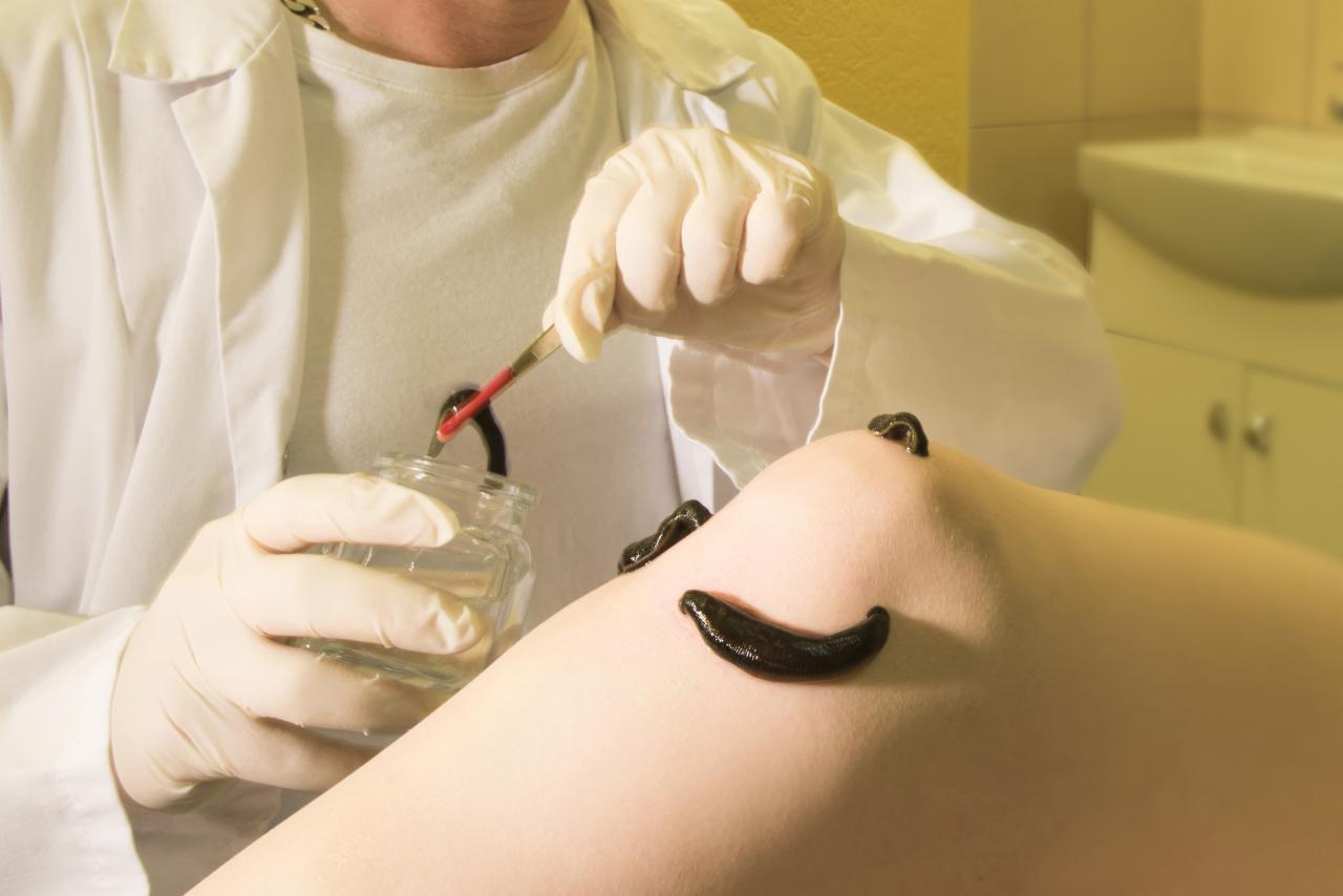 Lekarz w białym fartuchu i rękawiczkach aplikuje pijawki na kolano pacjenta za pomocą pęsety i słoika z wodą.