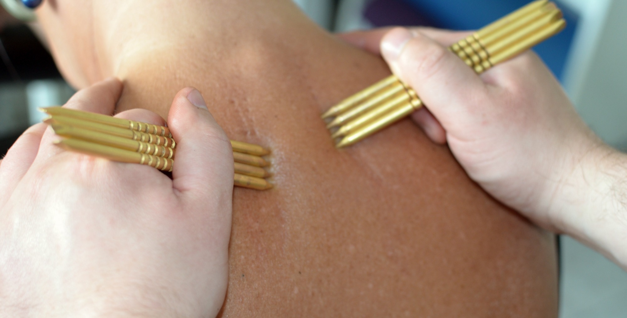 Bliski kadr: Dwie dłonie używają złotych, czteropunktowych narzędzi do masażu na skórze pleców, widoczne lekkie zaczerwienienia.