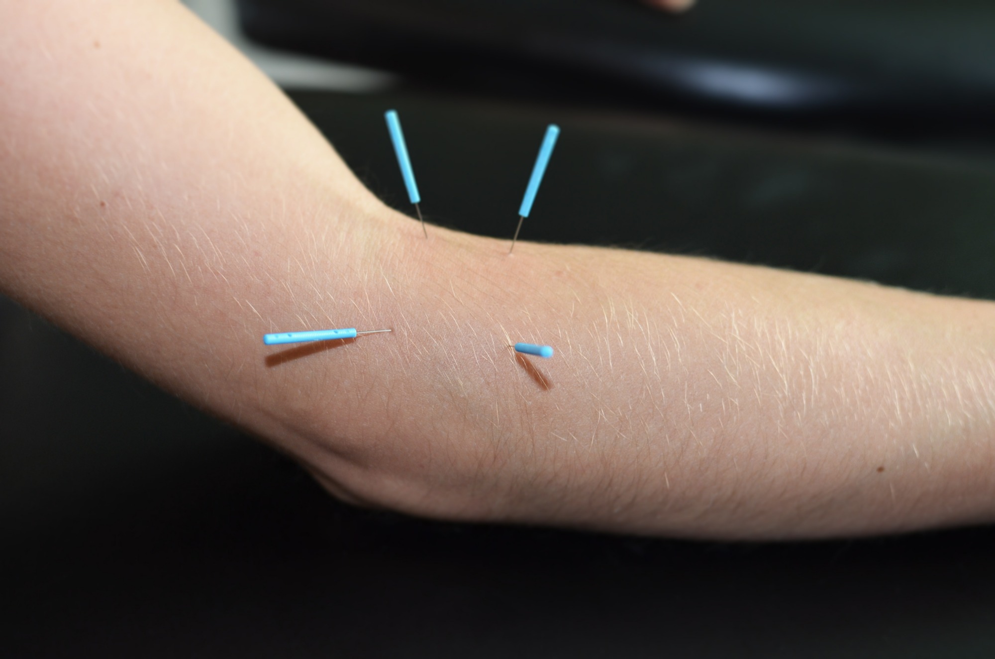 Przedramię pacjenta z czterema akupunkturowymi igłami z niebieskimi uchwytami, wbitymi w skórę, na czarnym tle.
