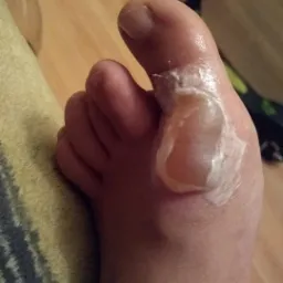 Oparzona stopa z opatrunkiem, widoczny pęcherz i krem, butelka wody w tle.