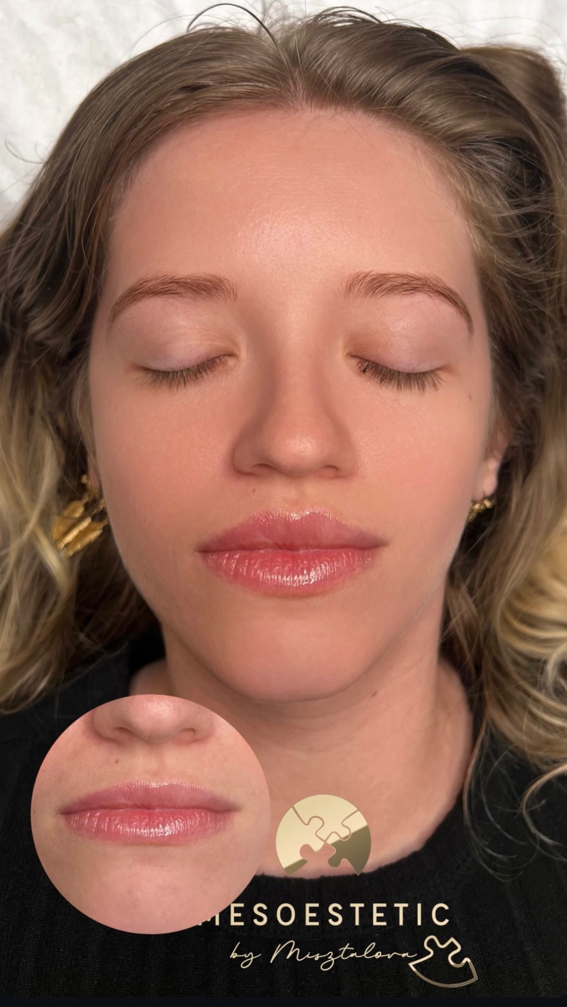 Subtelne modelowanie ust wraz z podniesieniem opadających kącików ust