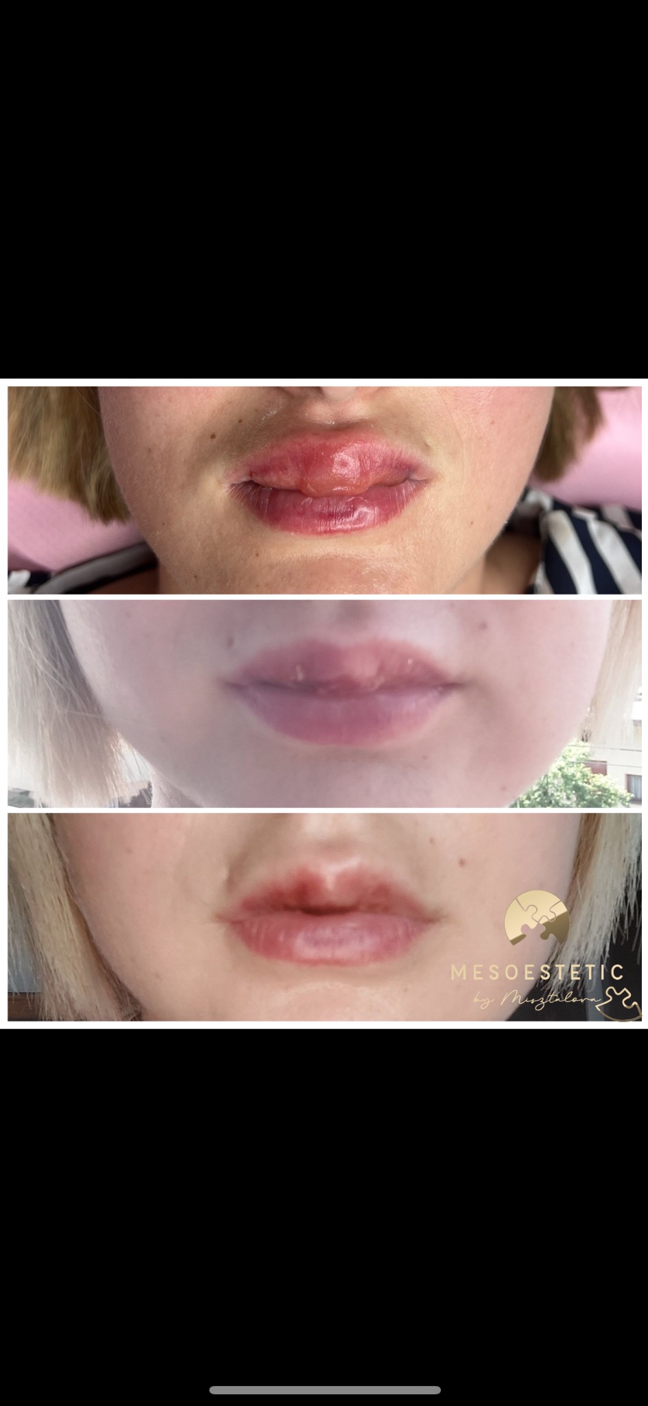 Porównanie ust przed i po korekcie nieudanego zabiegu modelowania. Górne ujęcie pokazuje usta z widoczną asymetrią i obrzękiem, środkowe ujęcie prezentuje stan po częściowej korekcie, a dolne...