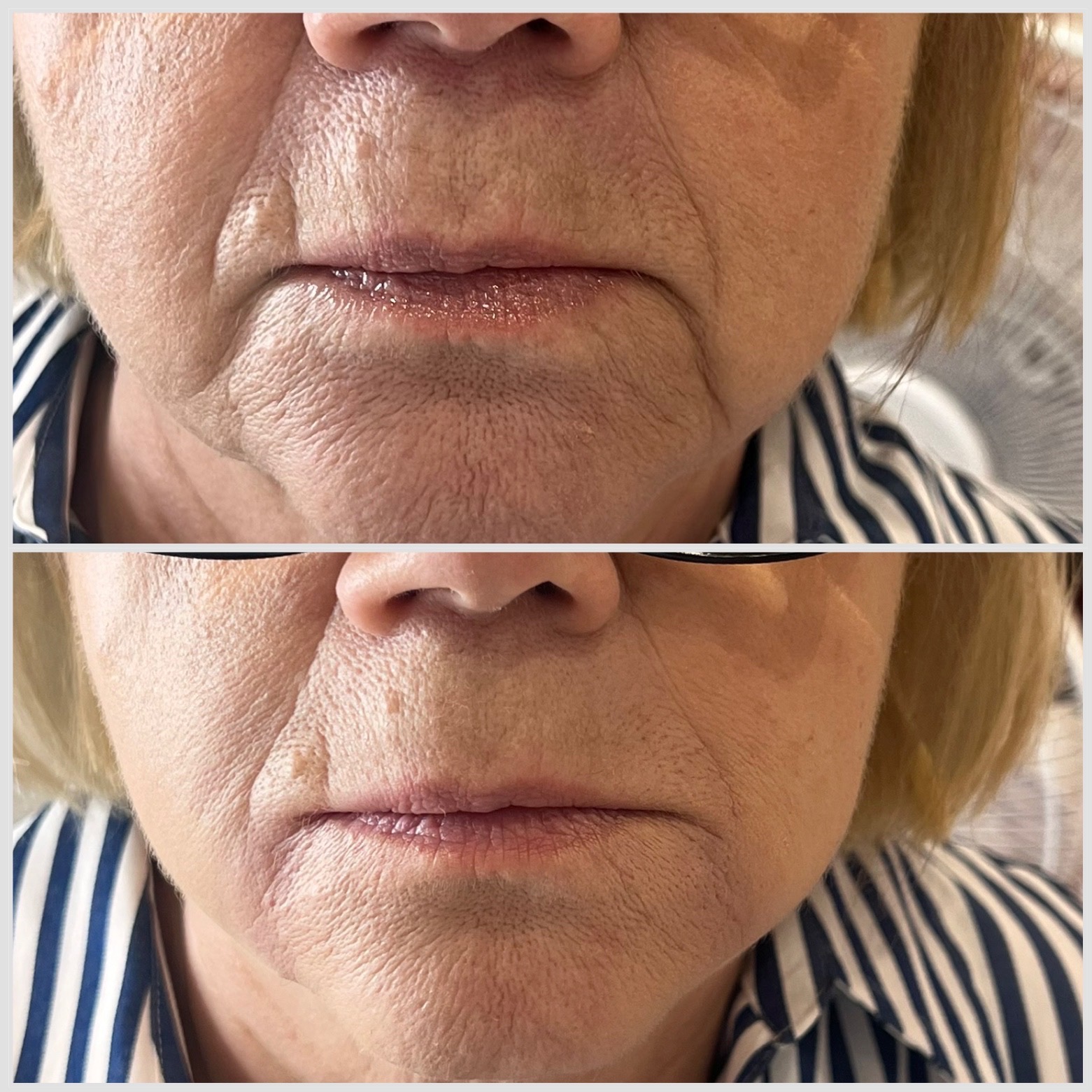 Zdjęcie przedstawia zbliżenie dolnej części twarzy kobiety przed i po zabiegu. Widoczne są zmarszczki wokół ust i brody przed zabiegiem (górna część zdjęcia) oraz redukcja tych zmarszczek po...