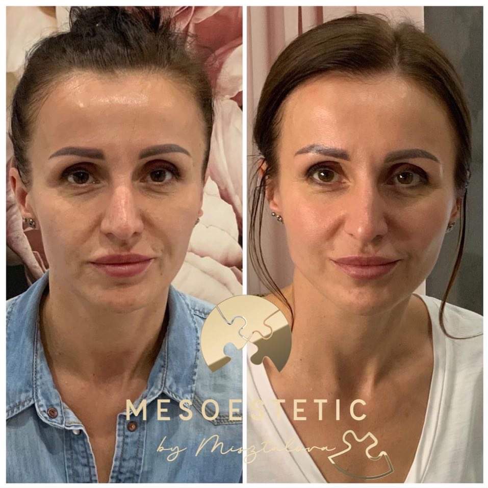 Portret kobiety przed i po zabiegu, widoczna poprawa stanu skóry i kolorytu, delikatne zmiany w konturze ust i brwi.