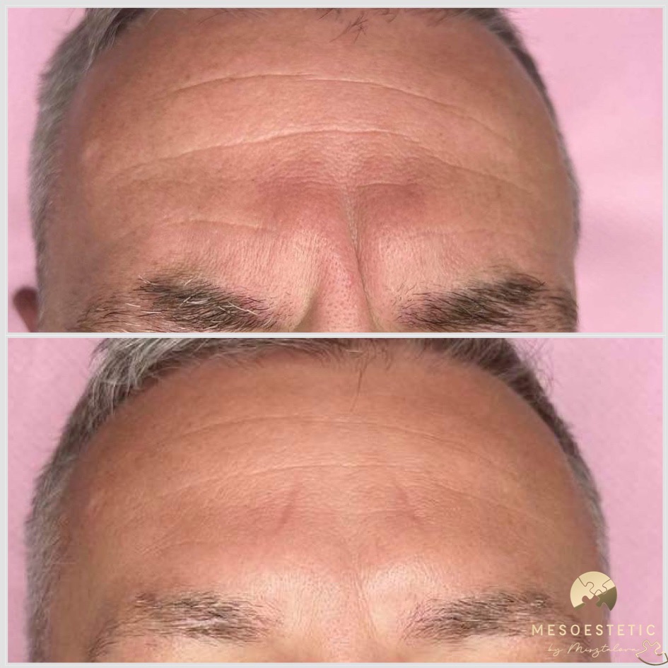 Zdjęcie przedstawia porównanie stanu skóry czoła mężczyzny przed i po zabiegu redukcji zmarszczek, ukazujące widoczne spłycenie linii i poprawę napięcia skóry.