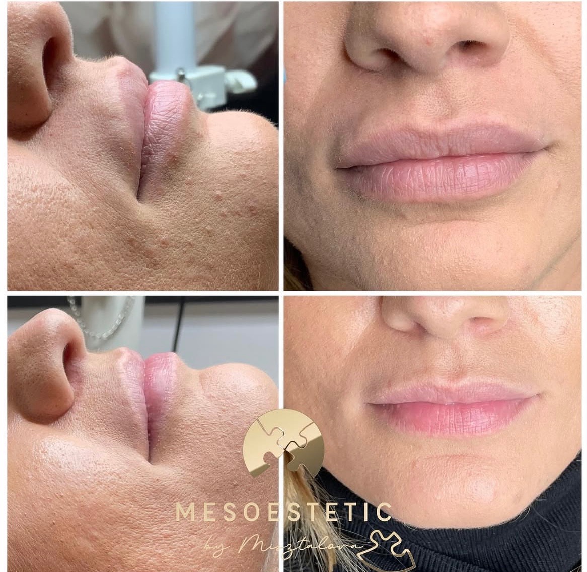 Kolaż przedstawiający ujęcie z bliska ust przed i po zabiegu powiększania, widoczne zmiany w objętości i konturze warg, dolny prawy kadr z logotypem firmy.