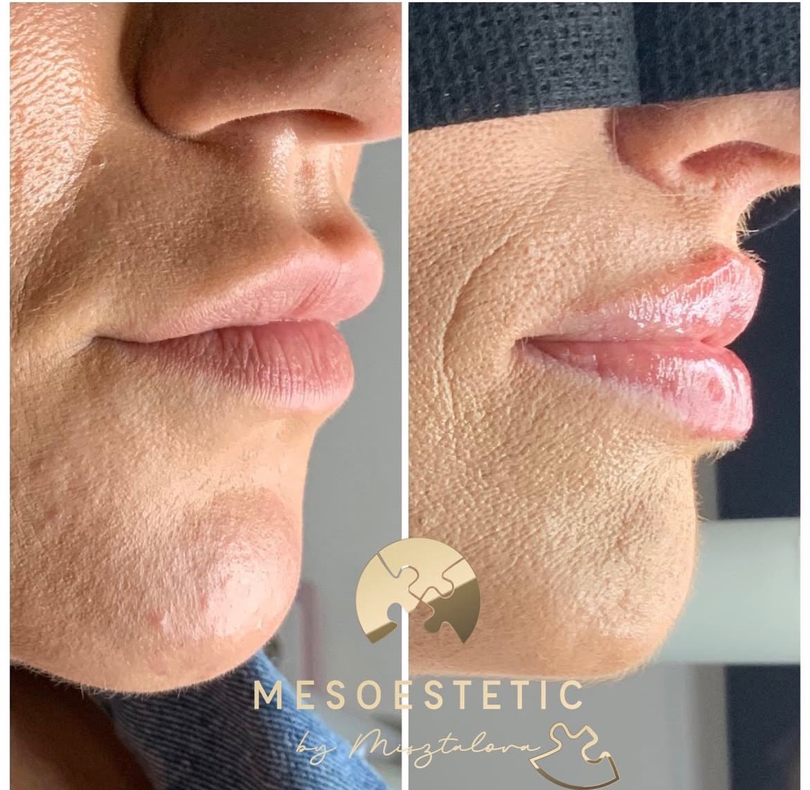 Porównanie ust przed i po zabiegu powiększania, widoczne zmiany w objętości i konturze, usta po zabiegu błyszczące, zbliżenie na profil twarzy.