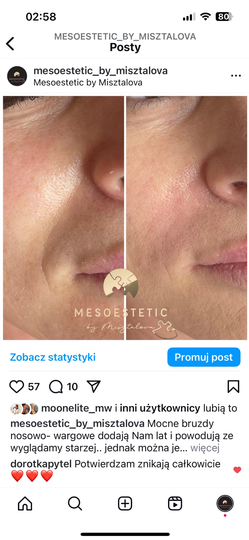 Zbliżenie twarzy kobiety przed i po zabiegu medycyny estetycznej, widoczne zmiany w strukturze skóry, redukcja zmarszczek nosowo-wargowych, podkreślone różnice w nawilżeniu i kolorycie skóry.