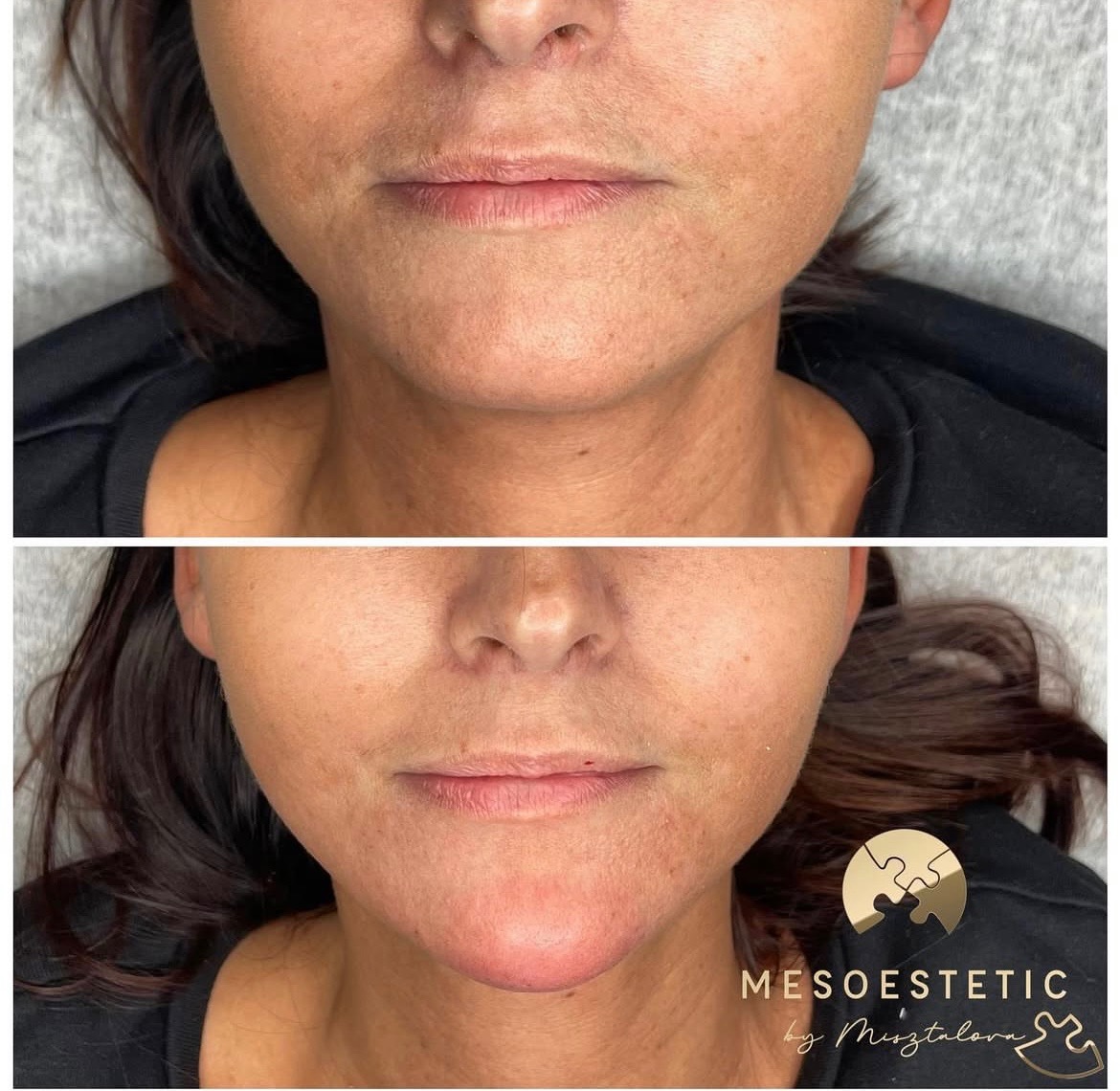 Portret twarzy kobiety przed i po zabiegu, widoczne zmiany w strukturze skóry i redukcja zmarszczek, z logo firmy w prawym dolnym rogu.