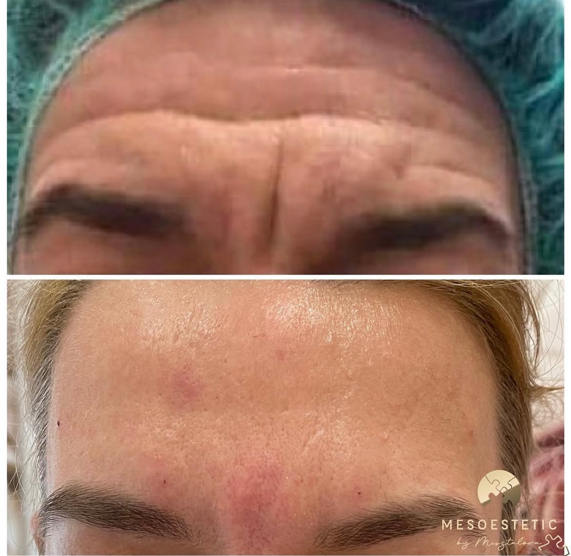 Zdjęcie przedstawia porównanie czoła klientki przed i po zabiegu wygładzenia zmarszczek, widoczne wyraźne zmniejszenie bruzd i poprawa napięcia skóry.