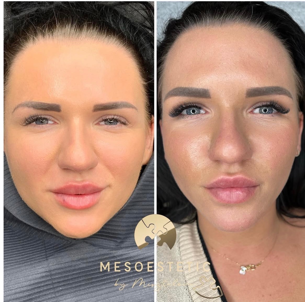 Zdjęcie typu przed i po przedstawia twarz kobiety. Po lewej stronie widoczna jest skóra przed zabiegiem, z drobnymi niedoskonałościami. Po prawej stronie, po zabiegu, skóra jest wyraźnie gładsza...