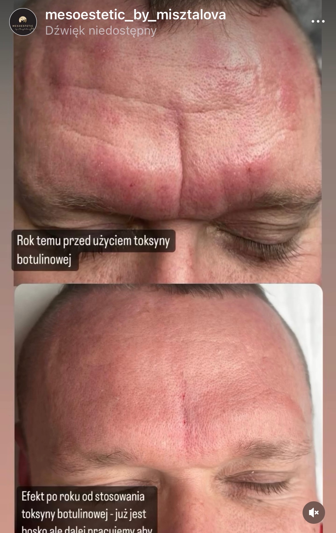 Zdjęcie porównawcze czoła mężczyzny przed i po rocznym stosowaniu toksyny botulinowej, ukazujące redukcję zmarszczek i napięcie skóry.