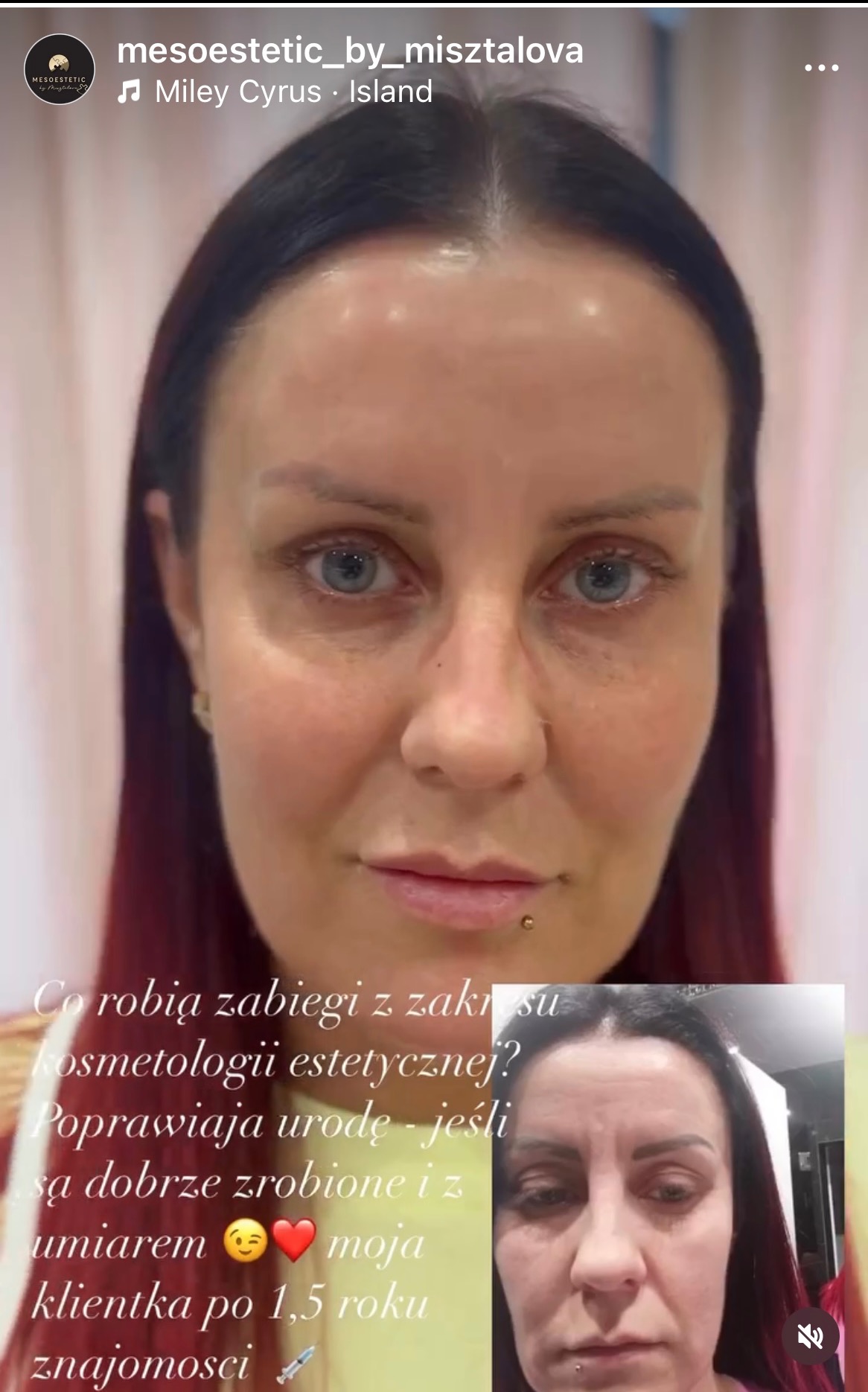 Portret kobiety z widocznym efektem zabiegów kosmetycznych, prezentujący poprawę wyglądu skóry twarzy, z małym zdjęciem porównawczym w prawym dolnym rogu.