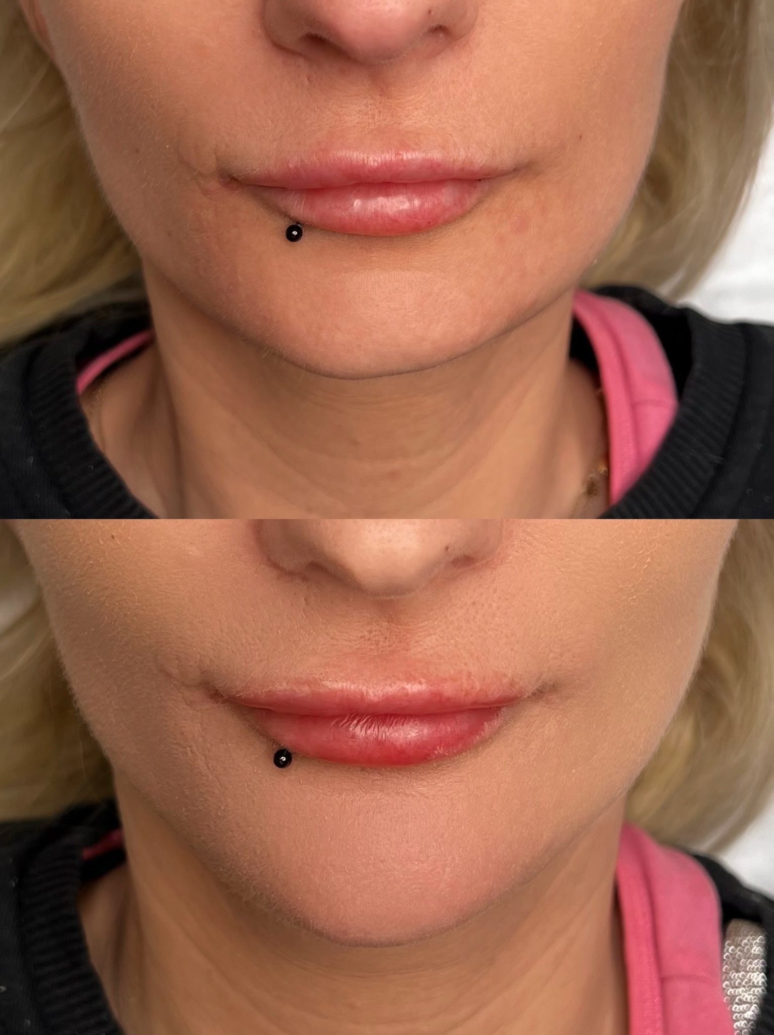 Zbliżenie na usta kobiety przed i po zabiegu powiększania, widoczny czarny kolczyk w wardze dolnej, uwydatnione kontury i objętość warg