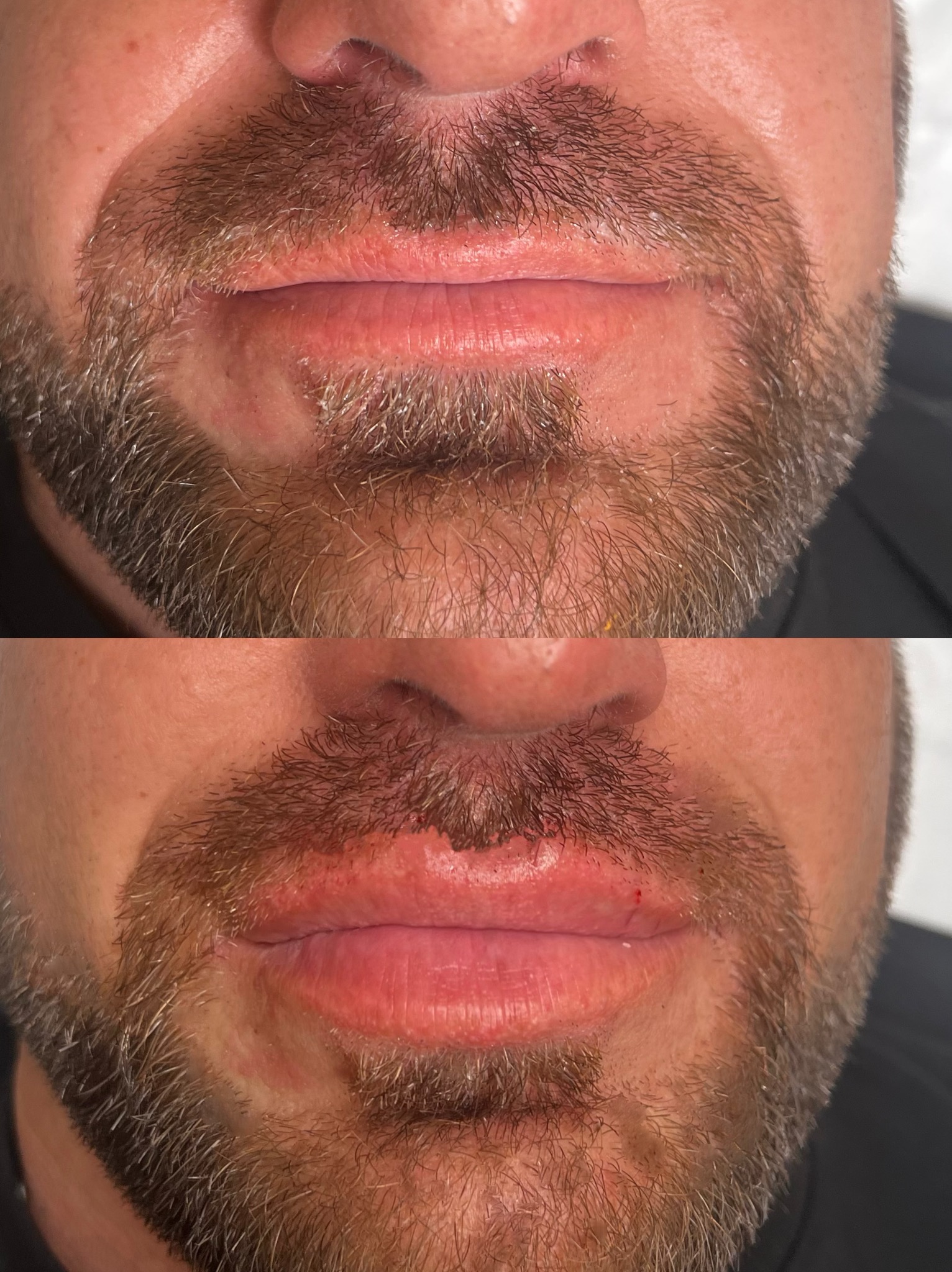 Mężczyzna z brodą, zbliżenie na usta przed i po zabiegu powiększania, widoczne zaczerwienienia i opuchlizna po zabiegu.