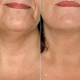 zabieg liftingujący