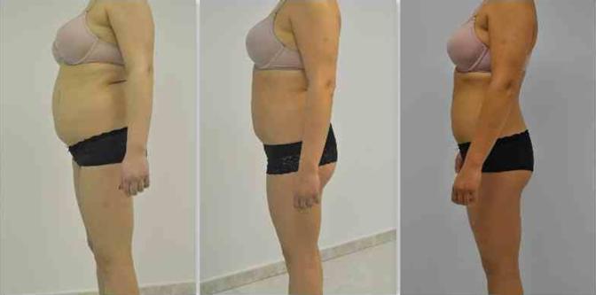 Efekt liposukcji kawitacyjnej