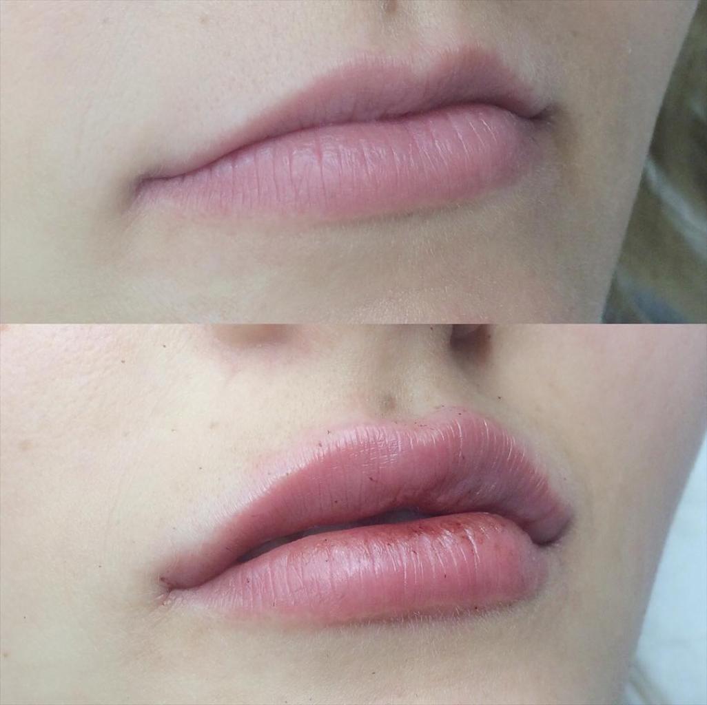 powiększanie ust kwasem HA