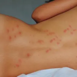 Plecy i bok osoby z licznymi, czerwonymi ugryzieniami owadów na skórze, widoczne ślady po ukąszeniach.