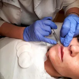 Powiększanie ust kwasem hialuronowym: kosmetyczka w niebieskich rękawiczkach wstrzykuje preparat w górną wargę pacjentki leżącej na białym podkładzie, widoczne waciki kosmetyczne obok.