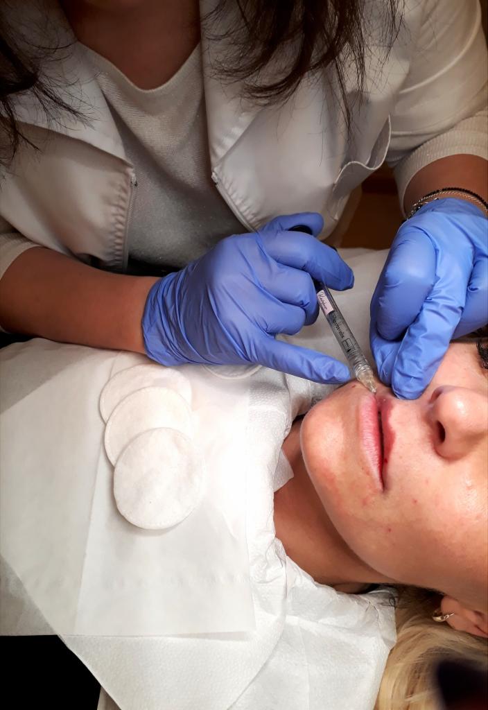 Powiększanie ust kwasem hialuronowym: kosmetyczka w niebieskich rękawiczkach wstrzykuje preparat w górną wargę pacjentki leżącej na białym podkładzie, widoczne waciki kosmetyczne obok.