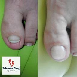 Rekonstrukcja paznokcia, zdjęcie przed i po