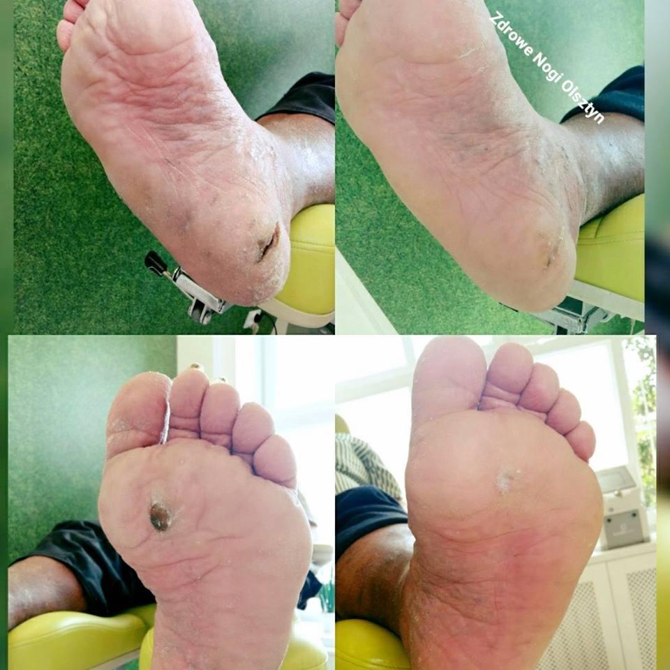 Odcisk i pęknięcie, zdjęcie przed i po