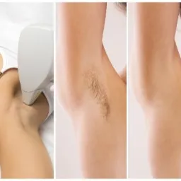 Depilacja Laseowa