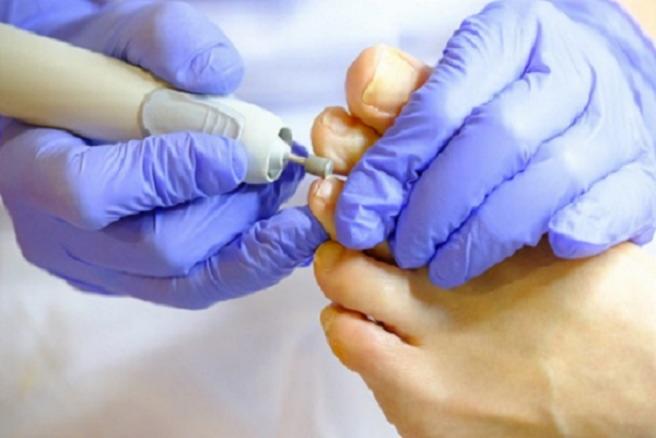 Stopa podczas zabiegu podologicznego z użyciem frezarki, dłonie w niebieskich rękawiczkach ochronnych.