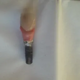 Model implantu z koroną zęba na białym tle, widoczne gwinty implantu i różowa imitacja dziąsła.