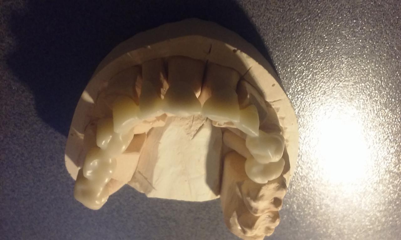 Gipsowy model szczęki z nałożonymi tymczasowymi koronami z tworzywa sztucznego, widoczne niedoskonałości wykończenia powierzchni.