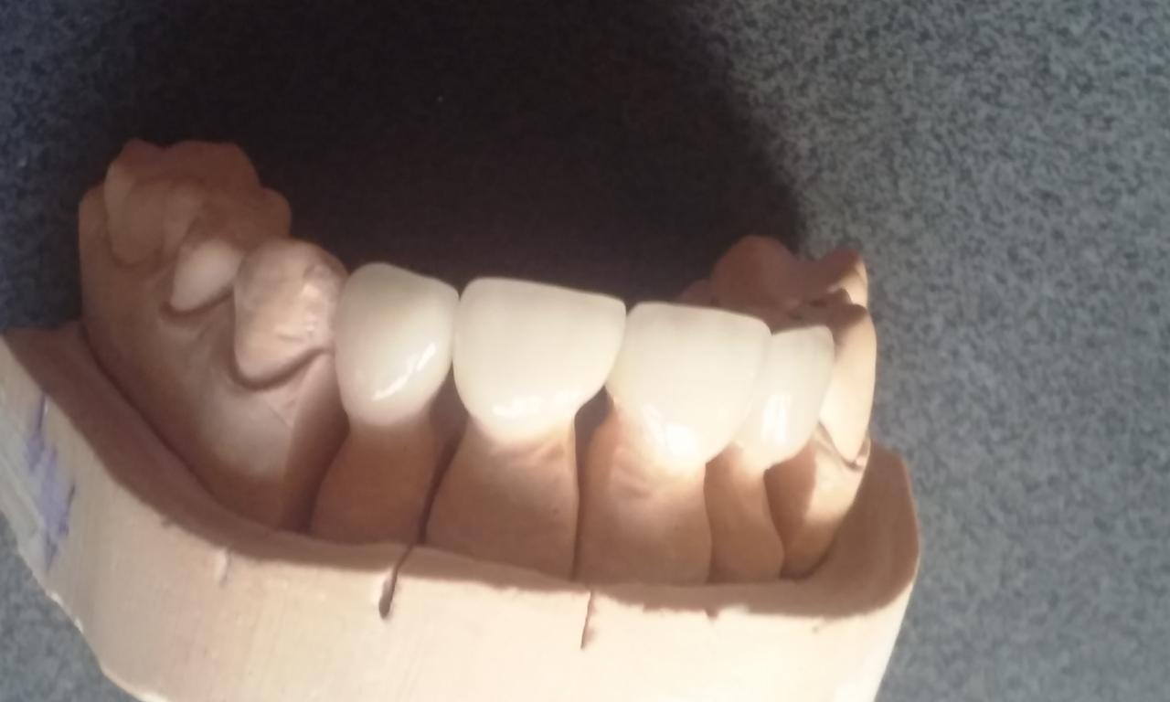 Model gipsowy z osadzonymi tymczasowymi koronami zębowymi o naturalnym odcieniu, widoczne drobne niedoskonałości gipsu i oznaczenia na modelu.