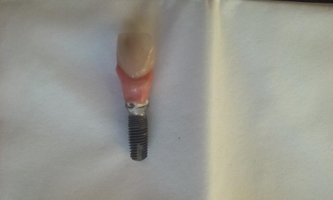 Model implantu z koroną zęba na białym tle, widoczne gwinty implantu i różowa imitacja dziąsła.