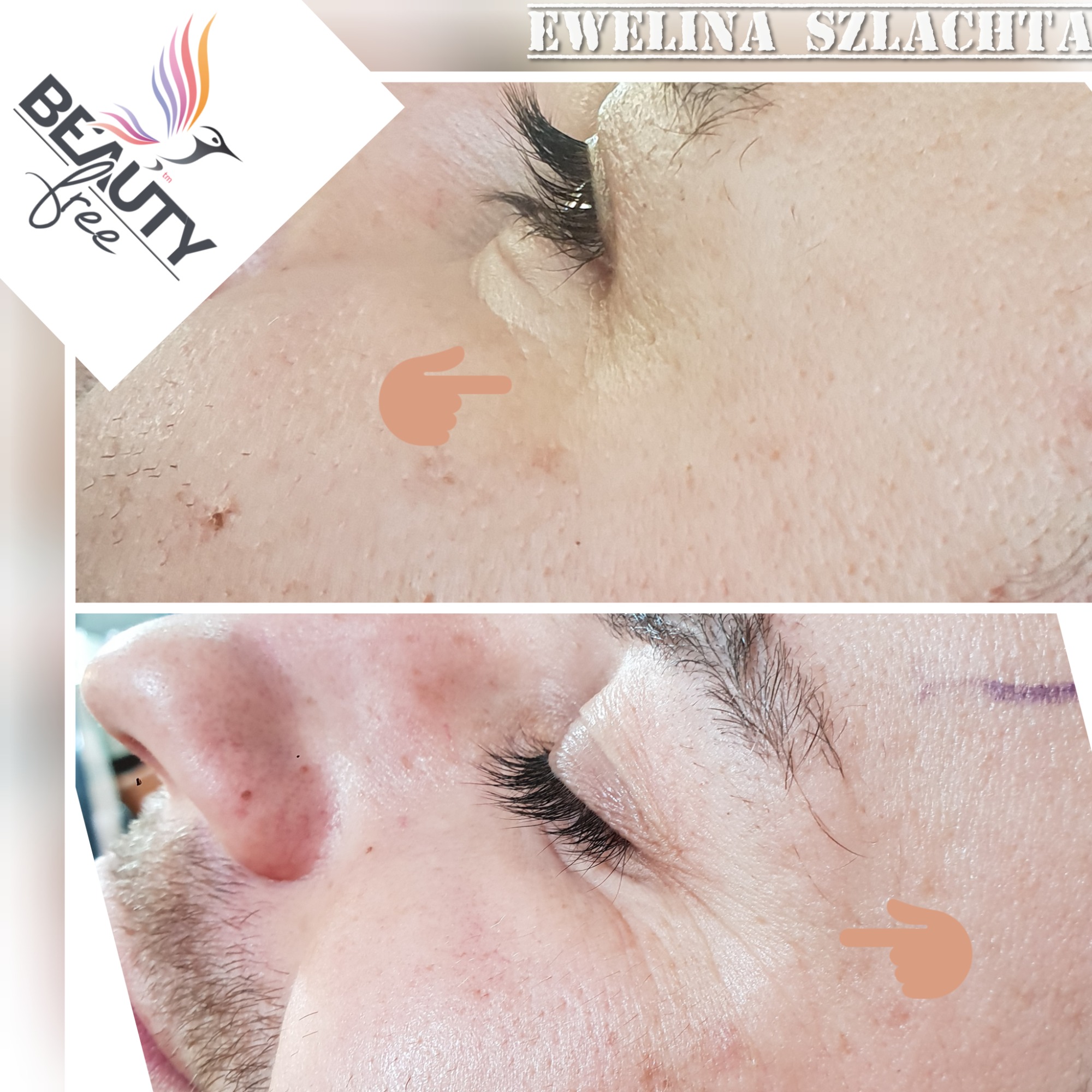 botox - kurze łapki