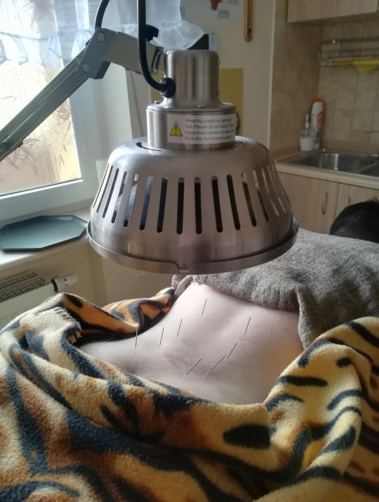 Pacjent pod lampą grzewczą z igłami akupunkturowymi na klatce piersiowej, przykryty kocem w tygrysi wzór.
