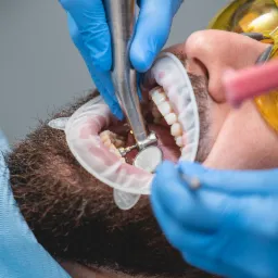 Pacjent z rozwartą jamą ustną podczas zabiegu, widoczne narzędzia w dłoniach lekarza w niebieskich rękawicach, ślinociąg, okulary ochronne i wiertło w trakcie pracy.