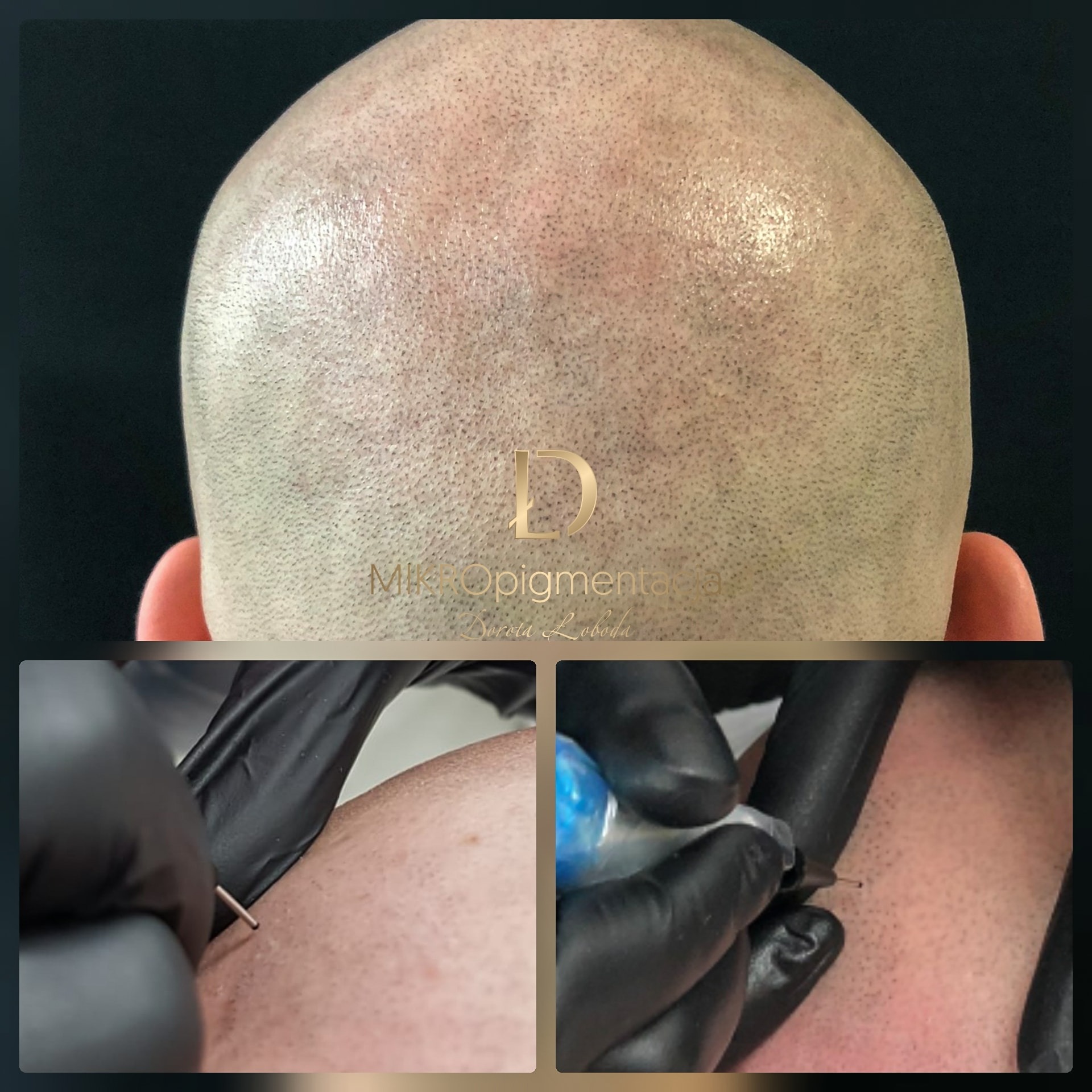 Górna część ogolonej głowy z widocznymi śladami pigmentacji skóry głowy, poniżej zbliżenia na proces mikropigmentacji skóry głowy przy użyciu specjalistycznego urządzenia z igłą.