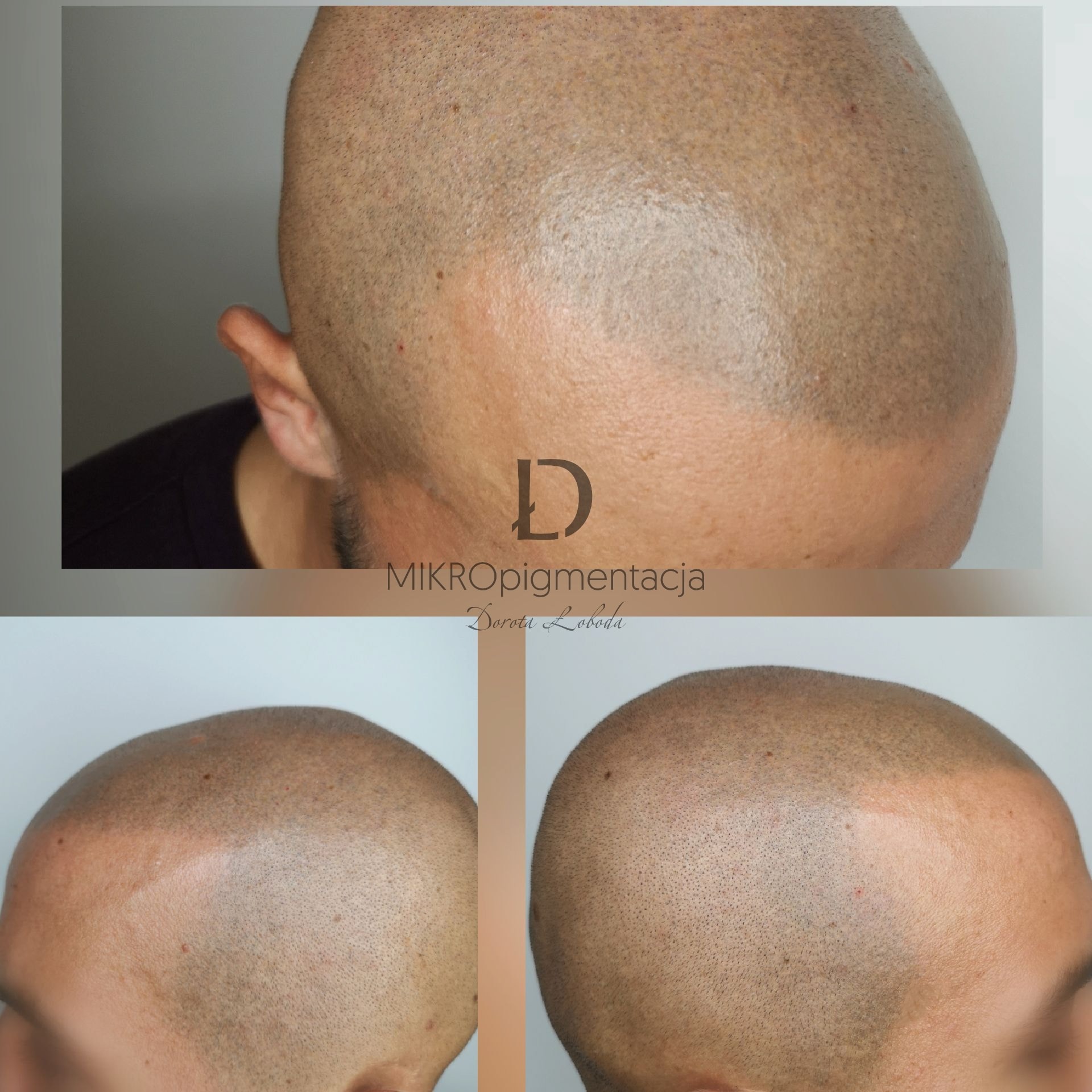 Górny widok głowy mężczyzny po zabiegu mikropigmentacji skóry głowy, prezentujący efekt zagęszczenia włosów, z widocznym logo firmy i zbliżeniem na obszar zabiegowy na dole zdjęcia.