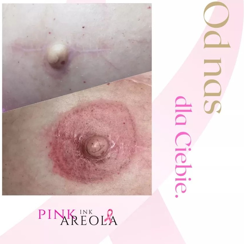 Zdjęcie przedstawia porównanie wyglądu piersi przed i po rekonstrukcji brodawki sutkowej z pigmentacją otoczki. Górny kadr ukazuje pierś z blizną pooperacyjną i brakiem brodawki, dolny kadr...