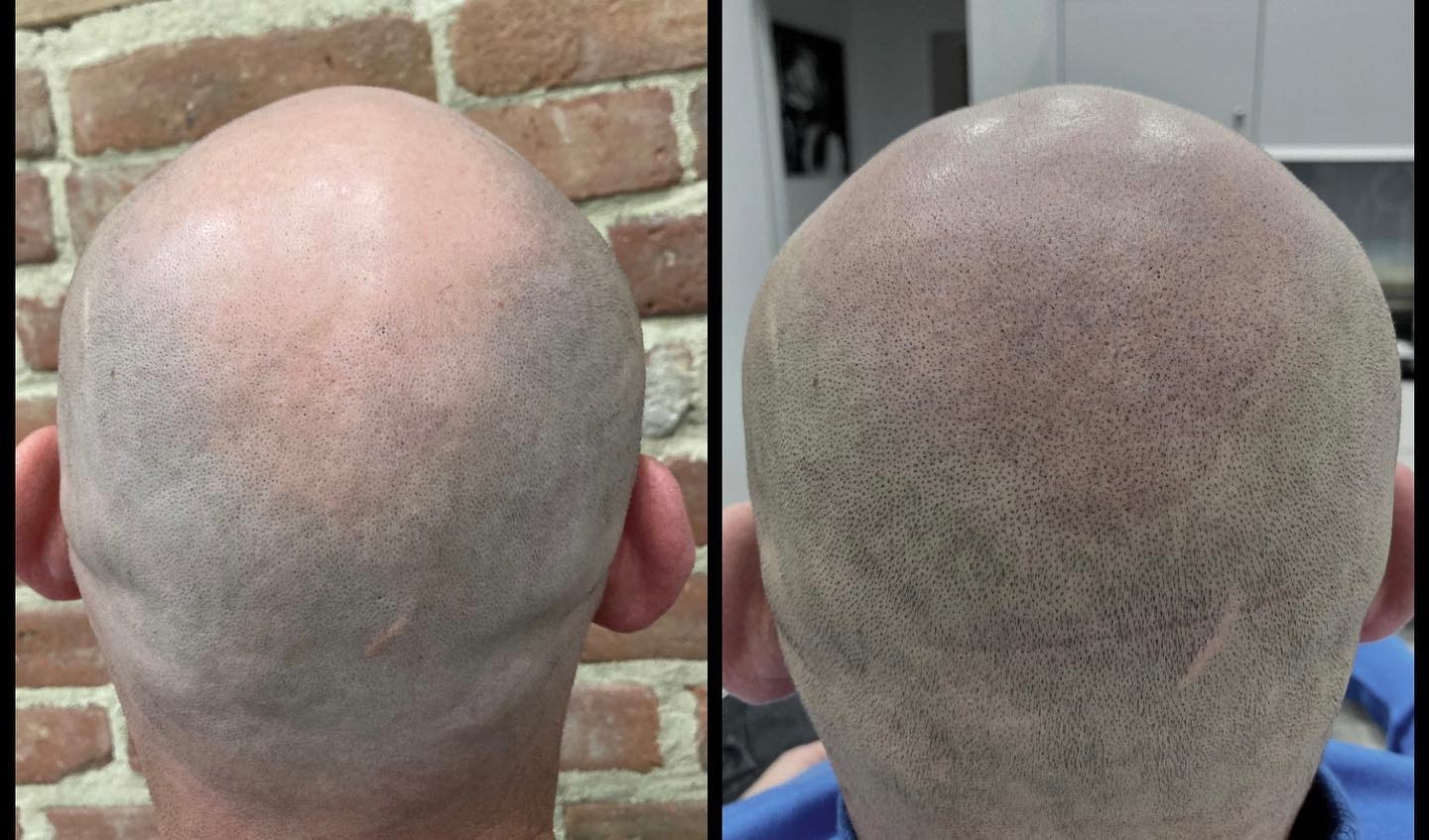 Głowa mężczyzny przed i po zabiegu mikropigmentacji skóry głowy, widoczne zagęszczenie włosów i wyrównanie koloru skóry.