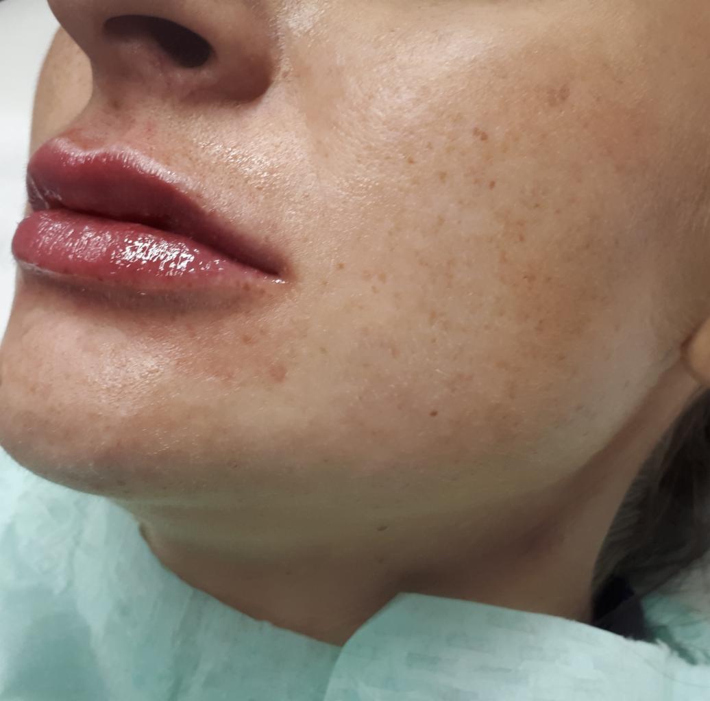 Artystyczne modelowanie ust kwasem hialuronowym