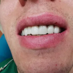 Uśmiech mężczyzny po zabiegu protetycznym, prezentujący pełny zestaw nowych, białych zębów. Widoczna dolna warga i fragment twarzy pacjenta.