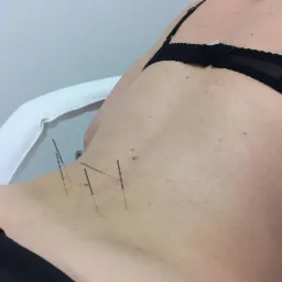 Kobieta leżąca na leżance z igłami do akupunktury wbitymi w dolną część pleców w pobliżu biodra.