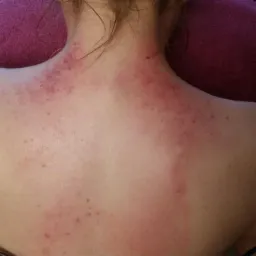 Plecy kobiety po zabiegu bańkami, widoczne zaczerwienienia i ślady po przyssawkach na skórze.