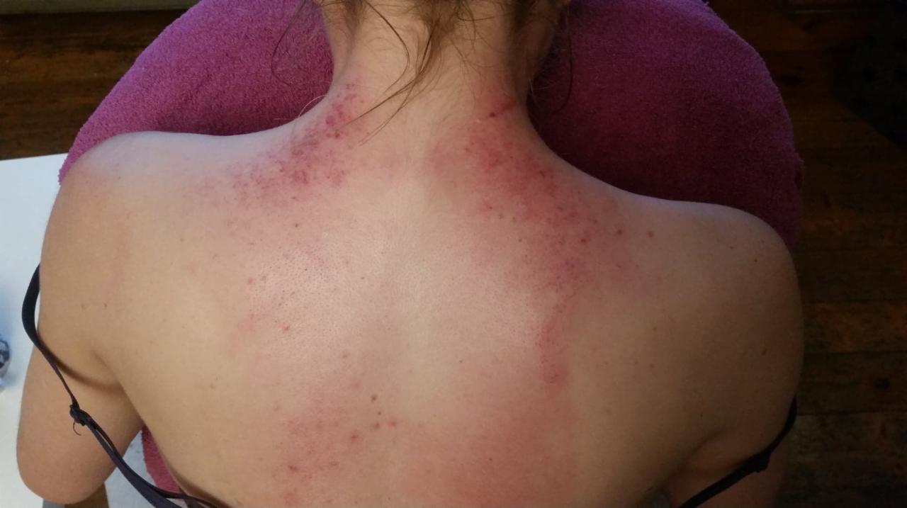 Plecy kobiety po zabiegu bańkami, widoczne zaczerwienienia i ślady po przyssawkach na skórze.