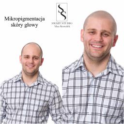 Najczęściej wybieranym zabiegiem w Smart Studio jest mikropigmentacja skóry głowy. Imitacja świeżo zgolonych włosów jest bardzo dobrą alternatywą dla przeszczepu włosów.

✅ Dawka satysfakcji gwarantowana

#liniafrontalnawlosow #mikropigmentacjaskoryglo