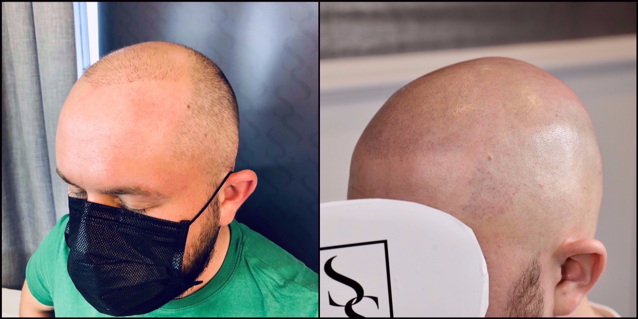 Mikropigmentacja skóry głowy: porównanie przed i po zabiegu, widoczna różnica w gęstości włosów na głowie mężczyzny.