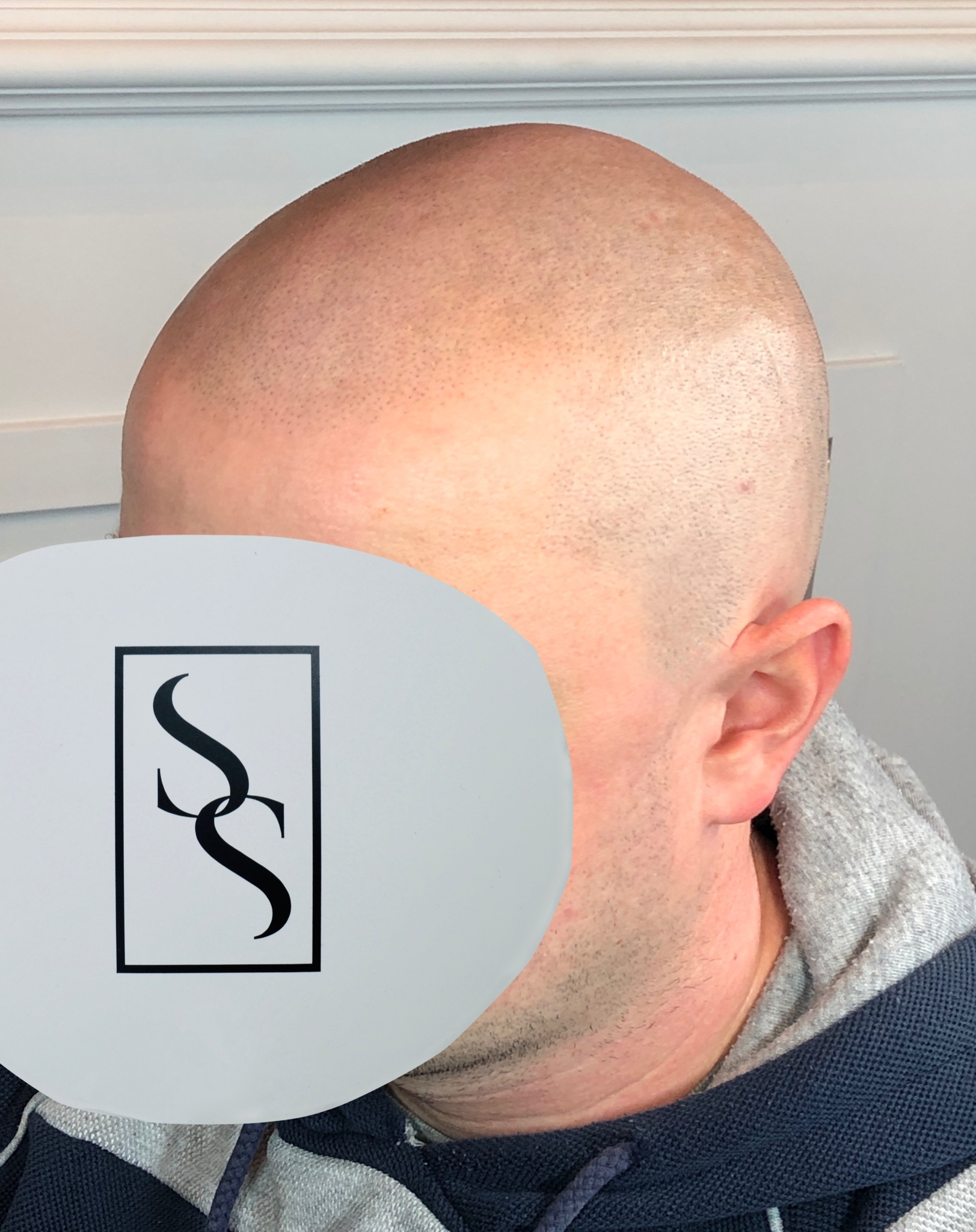 Pierwszy męski salon estetyczny w Trójmieście. Mikropigmentacja skóry głowy.