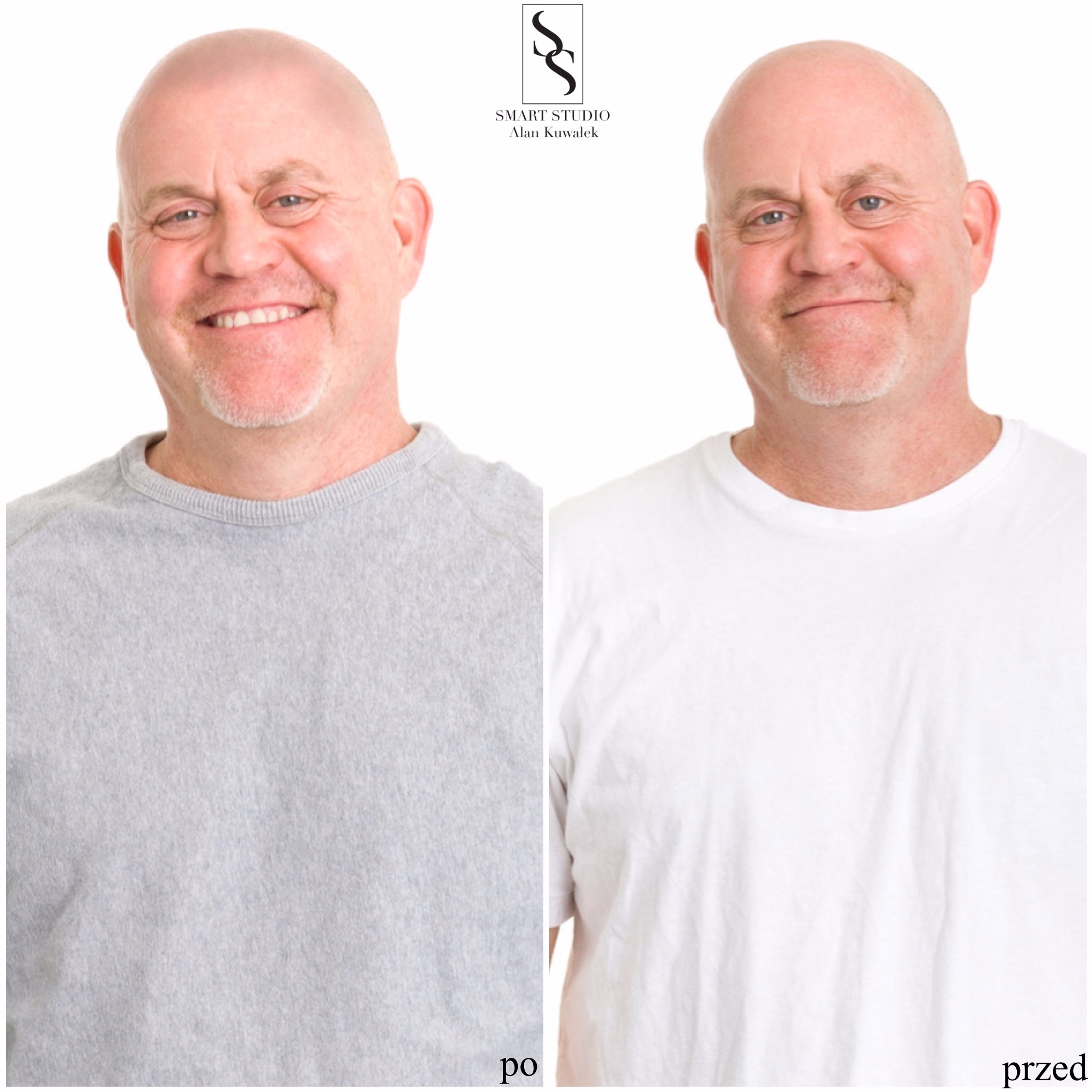 Mężczyzna przed i po mikropigmentacji skóry głowy, widoczne zagęszczenie włosów po zabiegu, porównanie sylwetki na białym tle z logo firmy Smart Studio Alan Kuwalek.